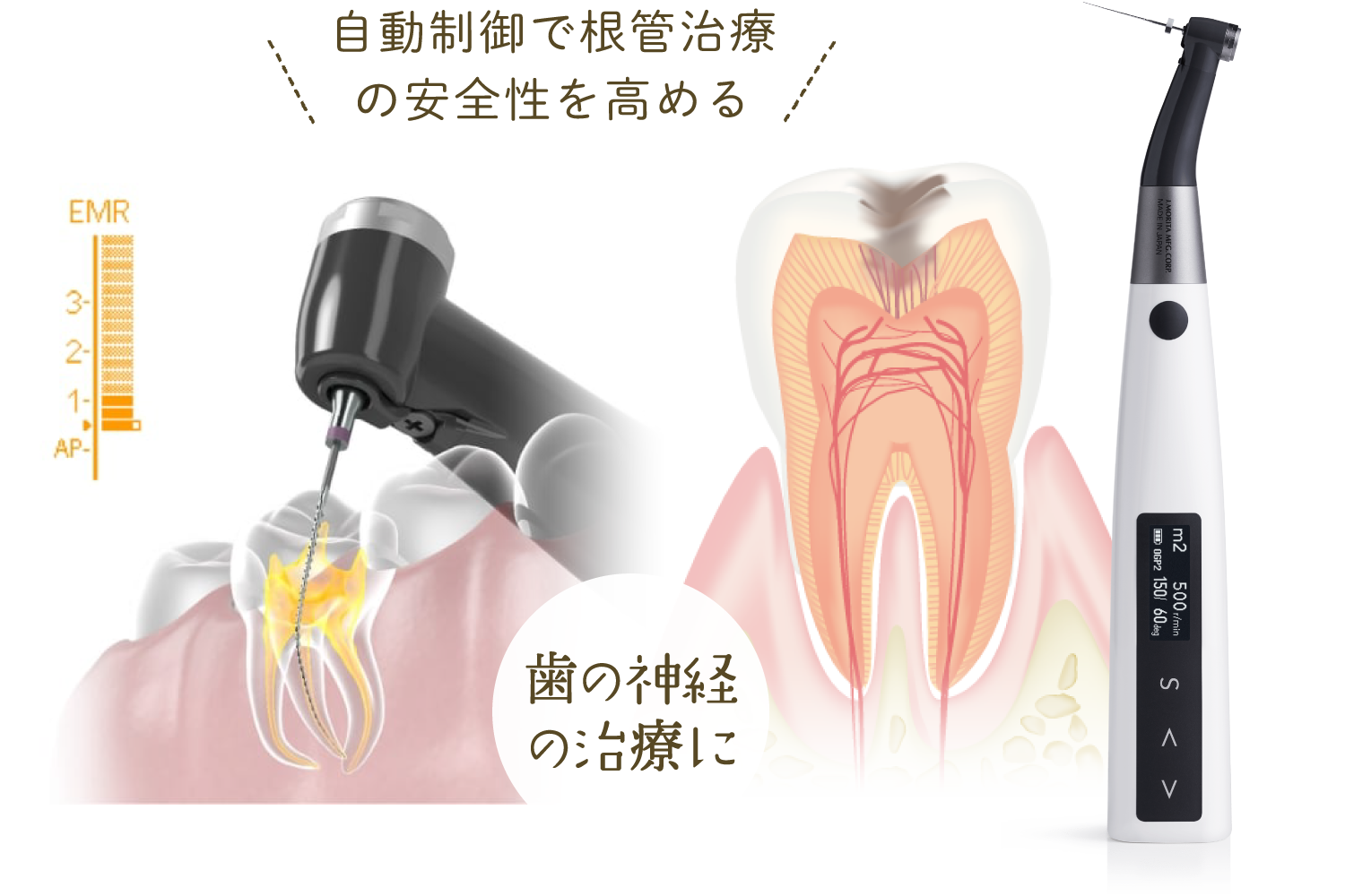 自動制御で根管治療の安全性を高める／歯の神経の治療に