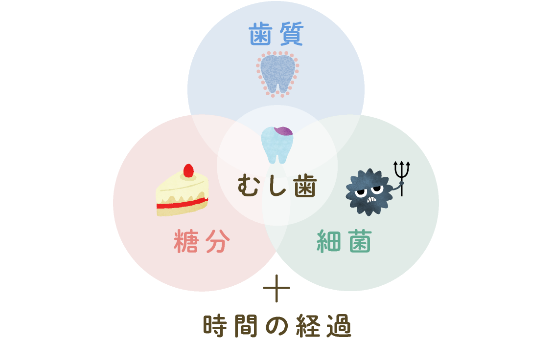 歯質＋糖分＋細菌＋時間の経過＝むし歯