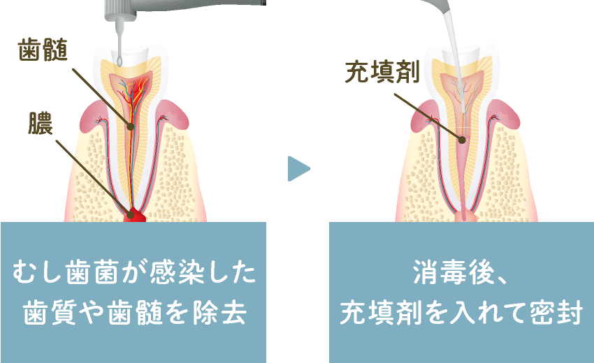 むし歯菌が感染した歯質や歯髄を除去 → 消毒後、充填剤を入れて密封