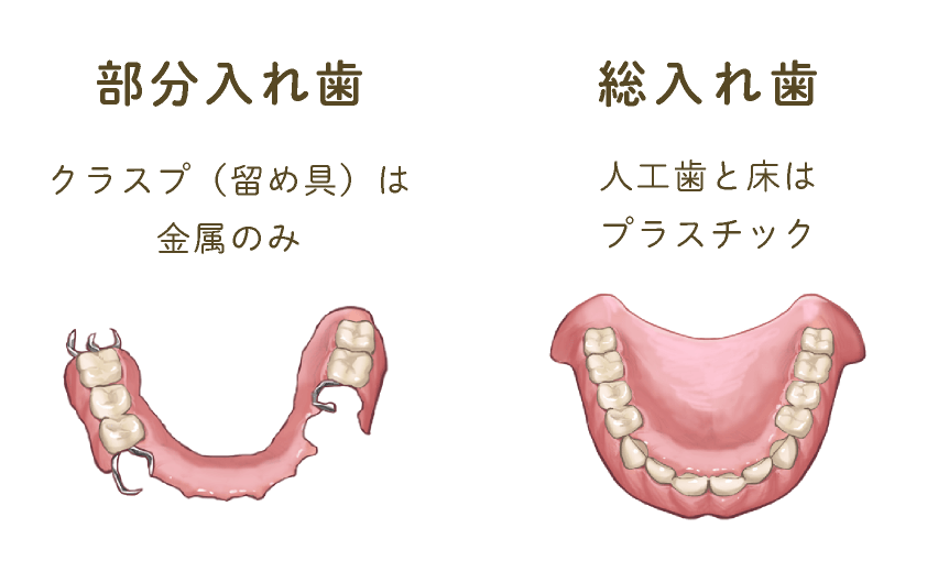 【部分入れ歯】クラスプ（留め具）は金属のみ　【総入れ歯】人工歯と床はプラスチック