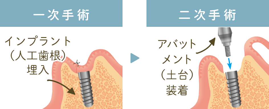 一次手術（インプラント埋入）、二次手術（アバットメント装着）