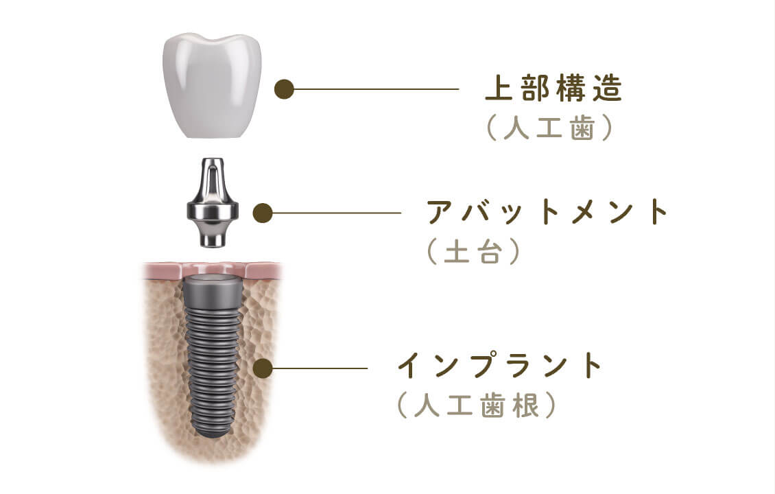 上部構造（人工歯）、アバットメント（土台）、インプラント（人工歯根）