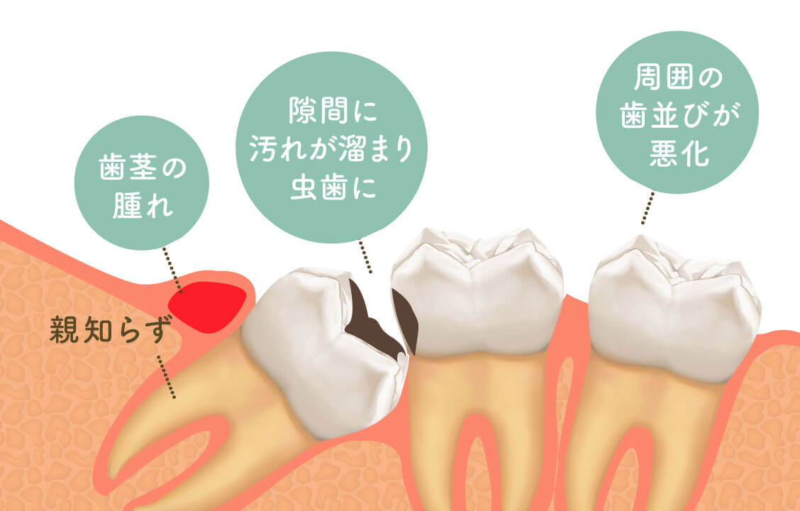 「親知らず」歯茎の腫れ／隙間に汚れが溜まり虫歯に／周囲の歯並びが悪化